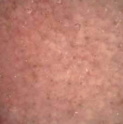 Auflichtmikroskopische Aufnahme von aktinischen Keratosen mit dem typischen Erdbeere-Muster